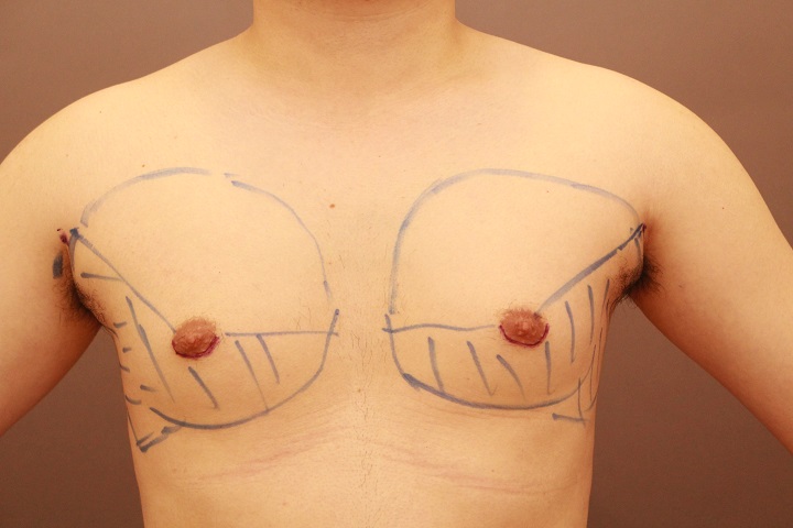 混合性女性化乳房