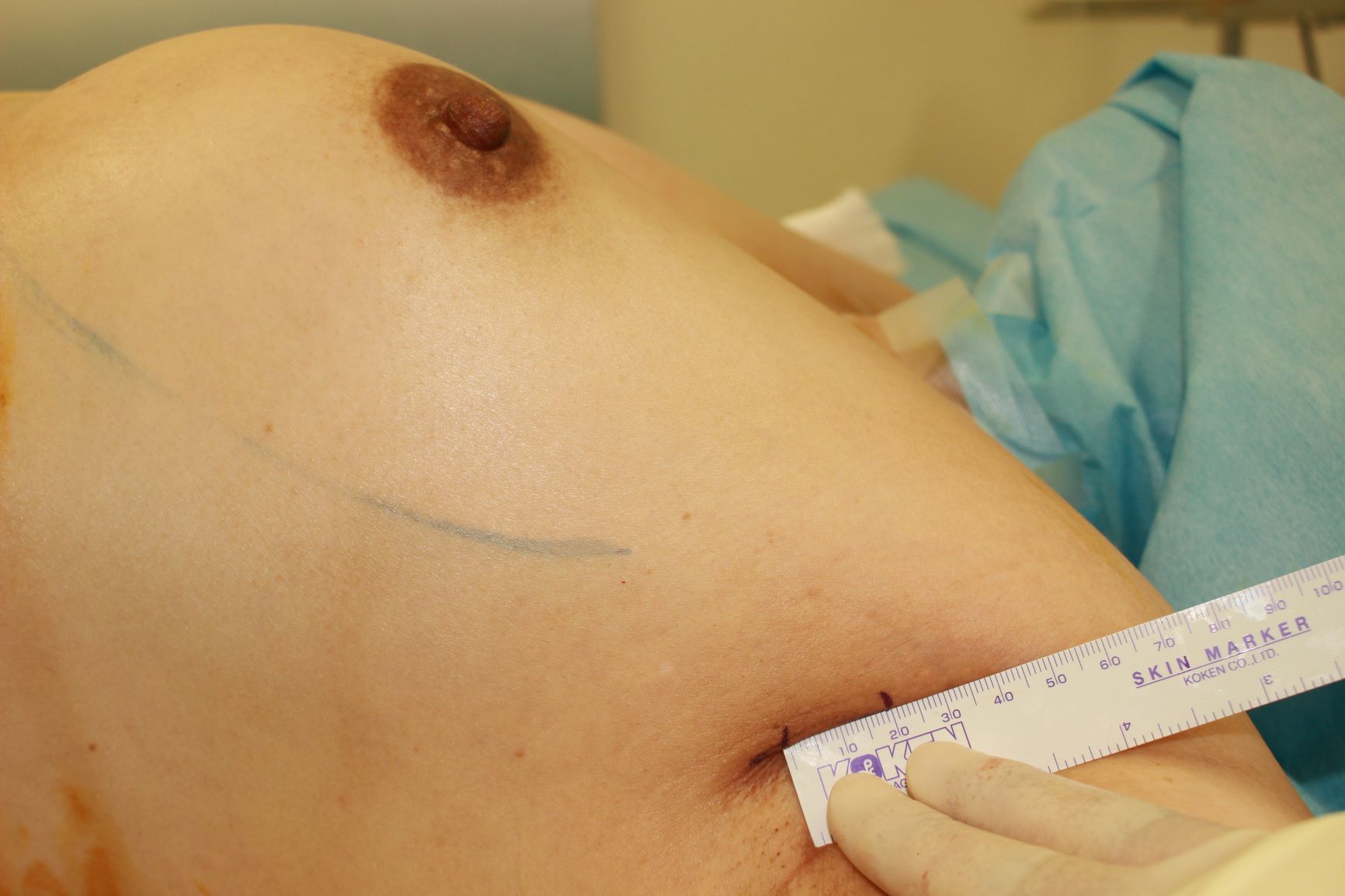 豊胸バック除去の傷