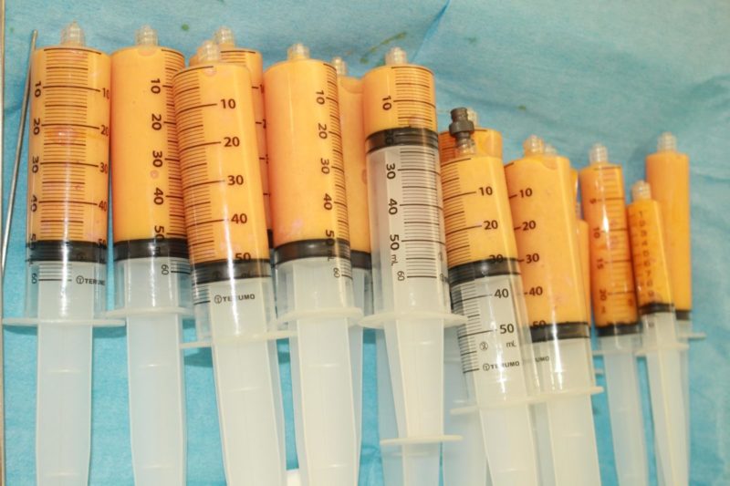 コンデンスリッチファット（CRF）豊胸