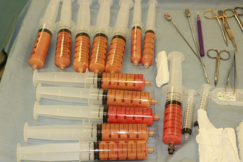 痩せている方のCRF豊胸