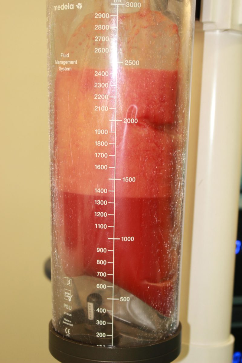 痩せている方のコンデンスリッチ豊胸