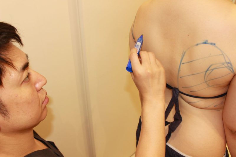 脂肪吸引のデザイン