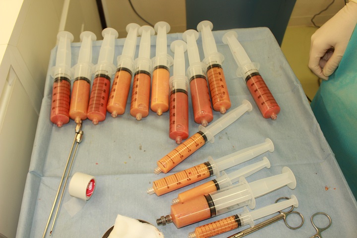 コンデンスリッチ豊胸