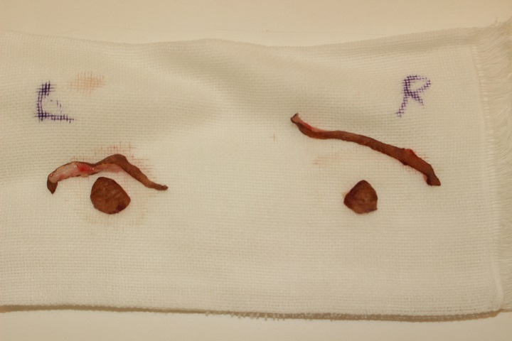 コンデンスリッチ豊胸＋乳頭縮小手術