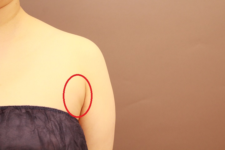 脇肉の脂肪吸引 2週間経過