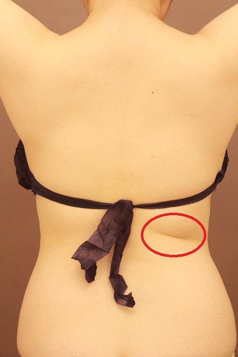 背中の脂肪吸引