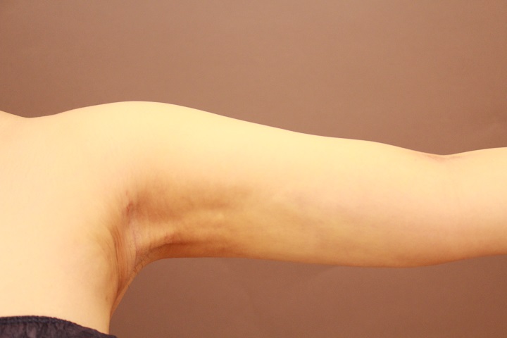 二の腕・肩の脂肪吸引　2週間経過