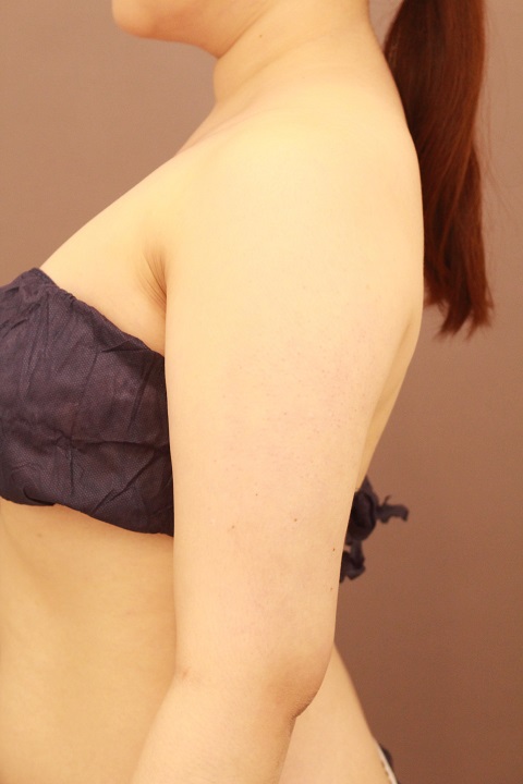 二の腕の脂肪吸引