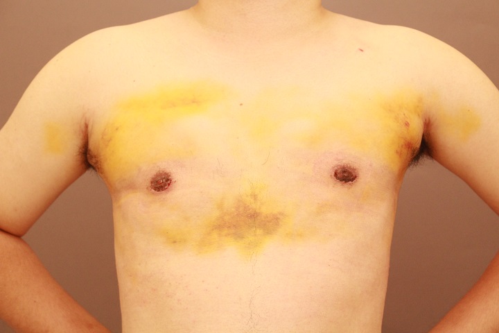 女性化乳房術後1週間の経過