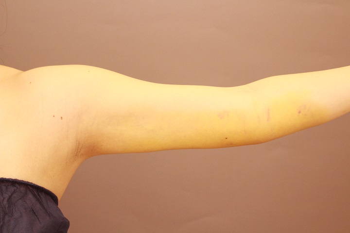 二の腕・肩の脂肪吸引 1週間経過