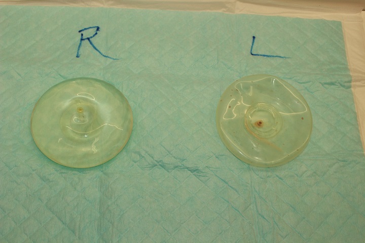 生理食塩水バッグ除去＆コンデンスリッチ豊胸