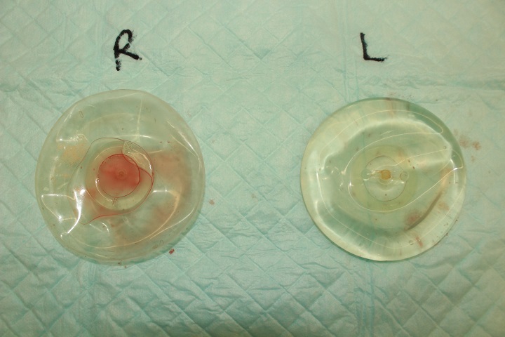 豊胸バッグ除去＋コンデンスリッチ豊胸