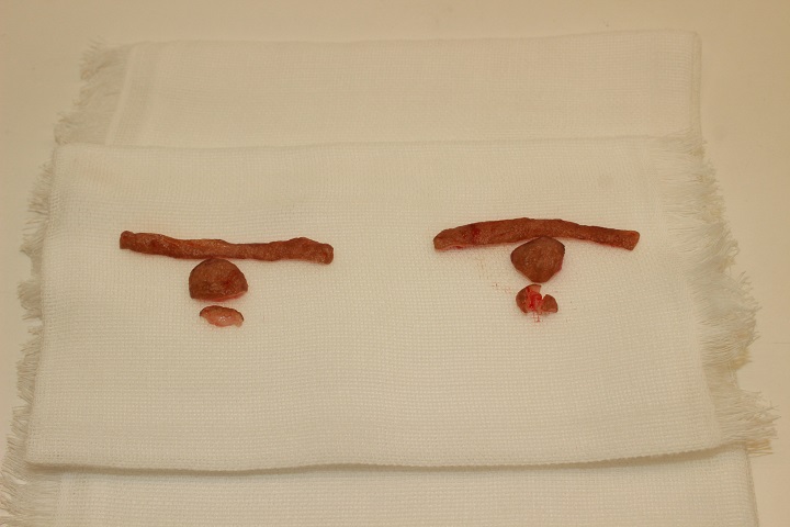 コンデンスリッチ豊胸＋乳頭縮小術