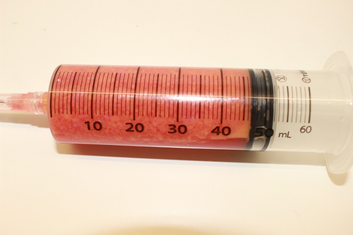 顎下・頬の脂肪吸引