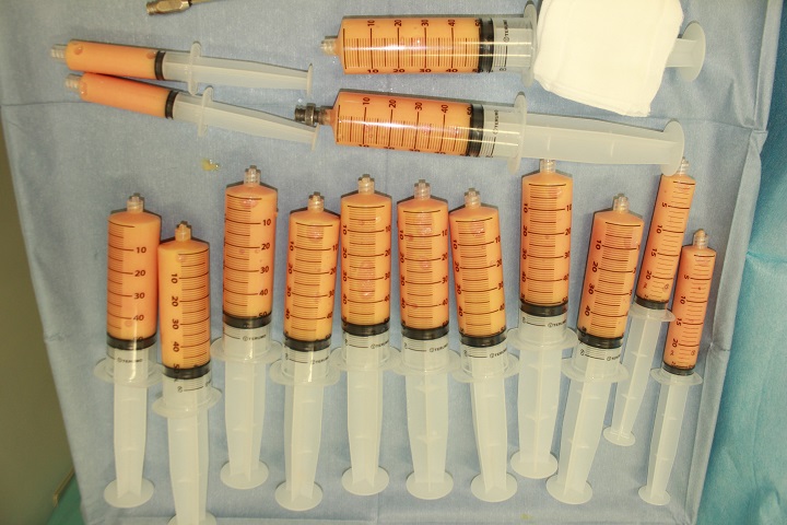 コンデンスリッチ豊胸