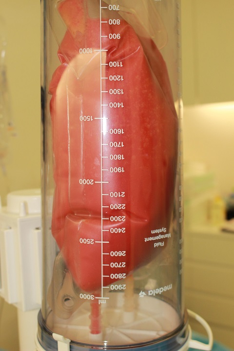 コンデンスリッチ豊胸