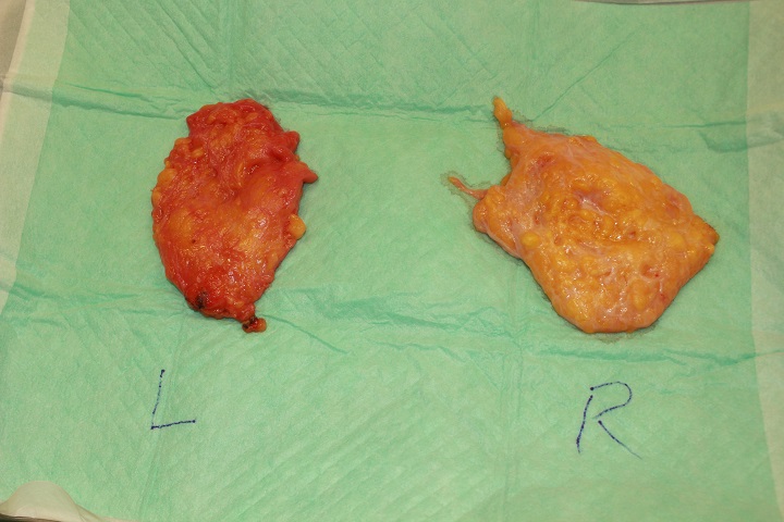 混合性女性化乳房