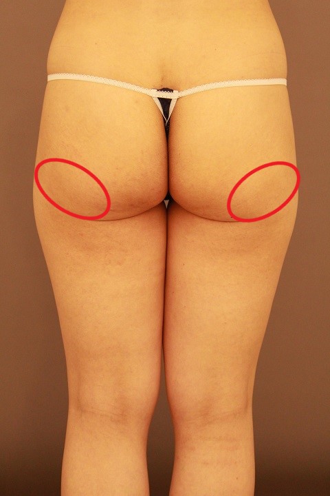 ふとももの脂肪吸引