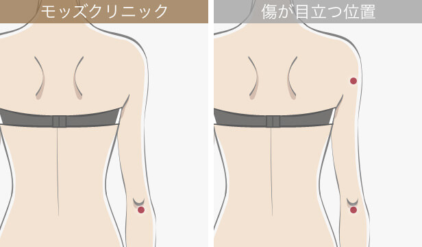 二の腕の脂肪吸引