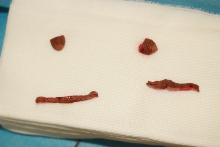 コンデンスリッチ豊胸＋乳頭縮小