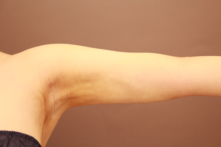 二の腕・肩の脂肪吸引 1か月後