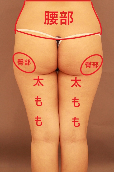 美尻になる脂肪吸引