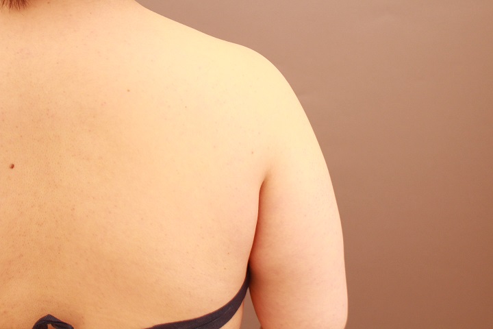 二の腕・肩の脂肪吸引