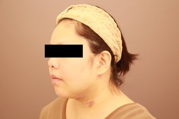 顔の脂肪吸引 翌日