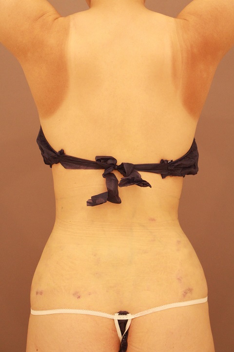 腰の脂肪吸引 1日目