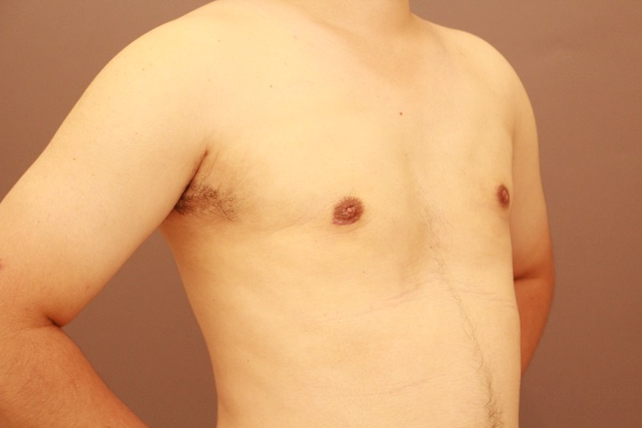 女性化乳房 術後1カ月経過