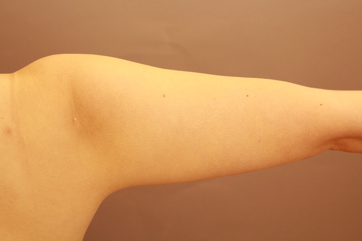 二の腕・肩の脂肪吸引