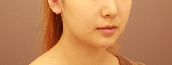 顎下・頬の脂肪吸引