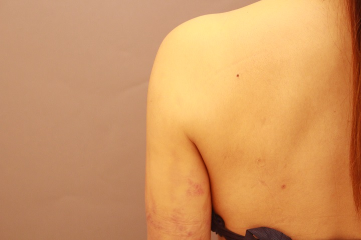 肩の脂肪吸引の翌日