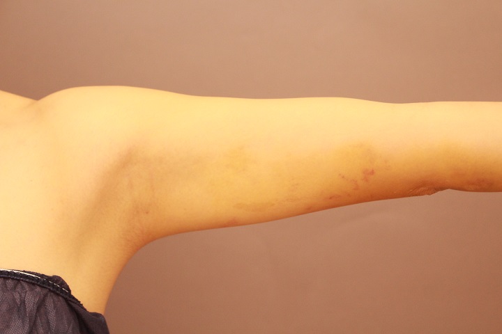 二の腕・肩の脂肪吸引