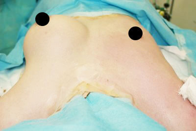 抜去後のバスト