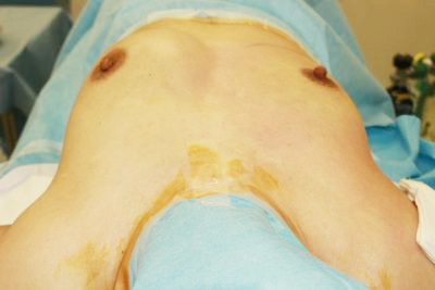 抜去後のバスト