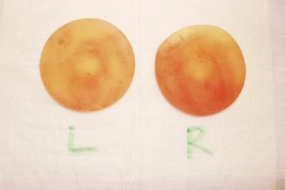 抜去したシリコンバッグ