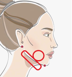 顔の脂肪吸引のダウンタイム