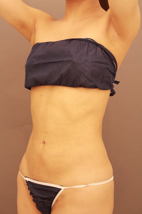 お腹の脂肪吸引