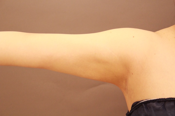 二の腕・肩の脂肪吸引