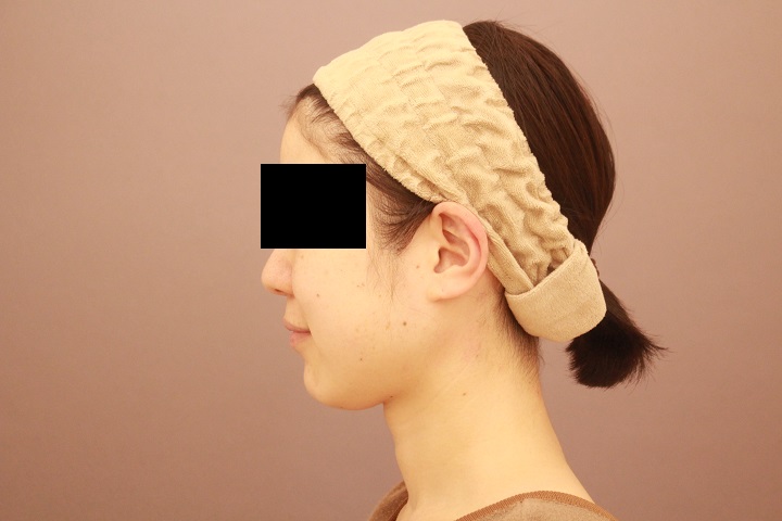 顎下の脂肪吸引