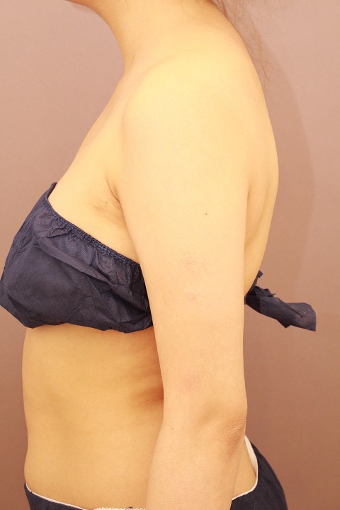 二の腕・肩の脂肪吸引