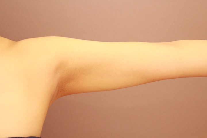 二の腕・肩の脂肪吸引