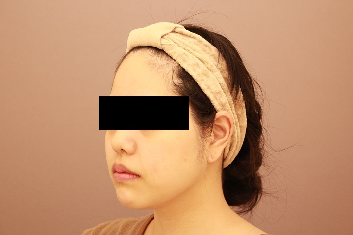 お顔の脂肪吸引