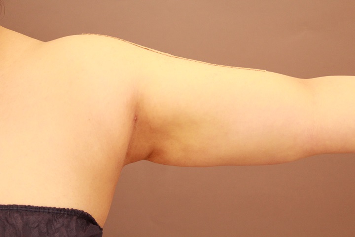 二の腕・肩の脂肪吸引 術後1カ月