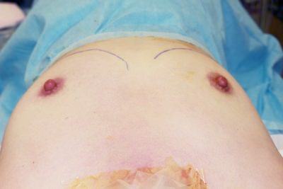 抜去後のバスト