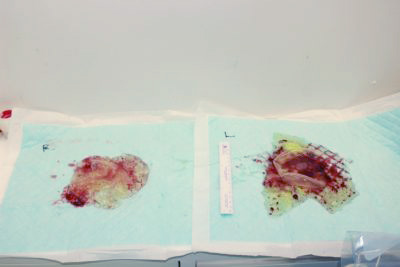 抜去したシリコンバッグ