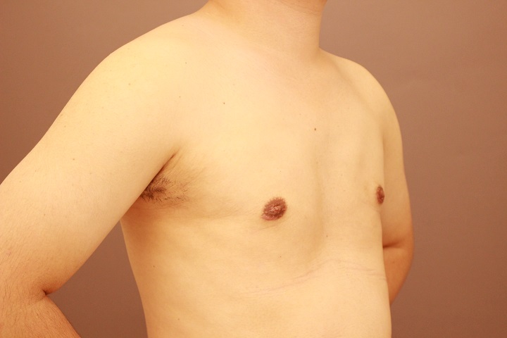女性化乳房 術後3カ月の経過