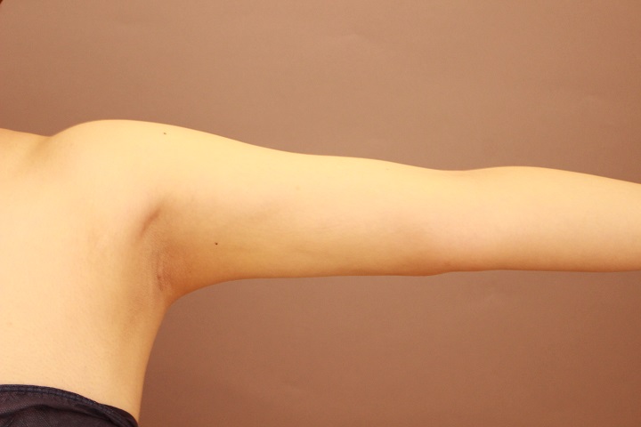 二の腕・肩の脂肪吸引　術後1カ月の経過