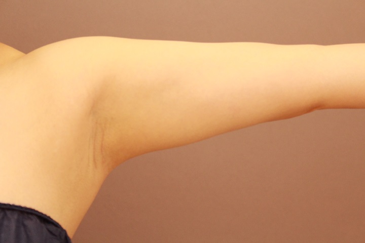 二の腕・肩の脂肪吸引 術後3カ月の経過